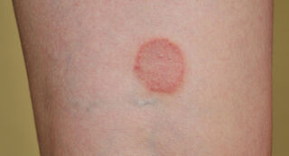 Herbal treatments for Ringworm